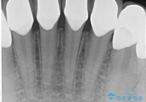 憧れの芸能人のような白い歯に 30代男性の治療後