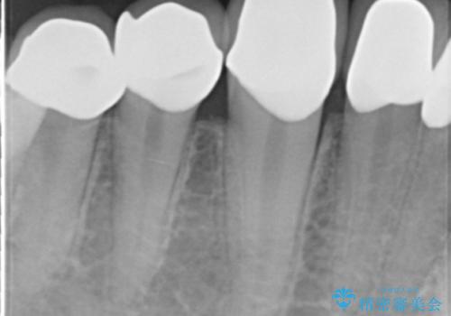 憧れの芸能人のような白い歯に 30代男性の治療後