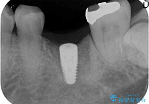強い噛み合わせによる歯牙破折後のインプラント治療の治療中