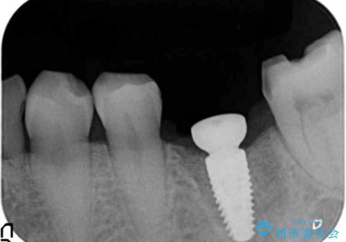 強い噛み合わせによる歯牙破折後のインプラント治療の治療中