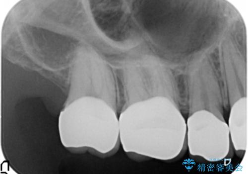 憧れの芸能人のような白い歯に 30代男性の治療後