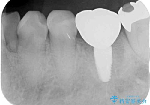 強い噛み合わせによる歯牙破折後のインプラント治療