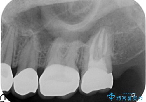 憧れの芸能人のような白い歯に 30代男性の治療後