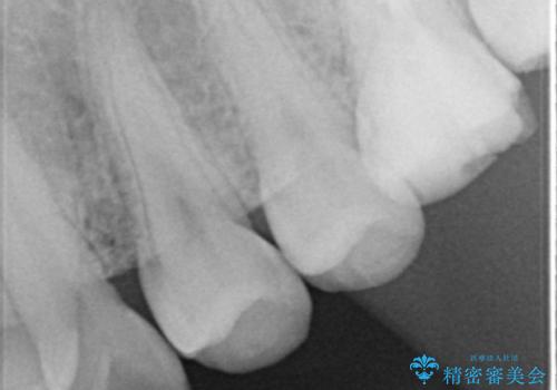 歯の位置異常 はやく治したい 矯正は嫌 20代女性の治療前