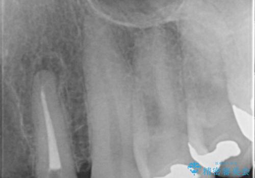 転んで前歯が2本ぬけた 自然なブリッジへ 60代男性の治療前