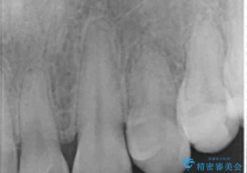 Kポップアイドルのような歯にしたい! 20代男性の治療前