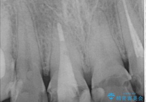 憧れの芸能人のような白い歯に 30代男性の治療前
