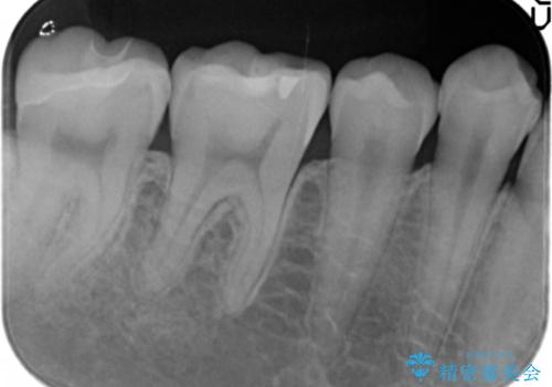 奥歯にフロスを通すと臭い 30代女性の治療後