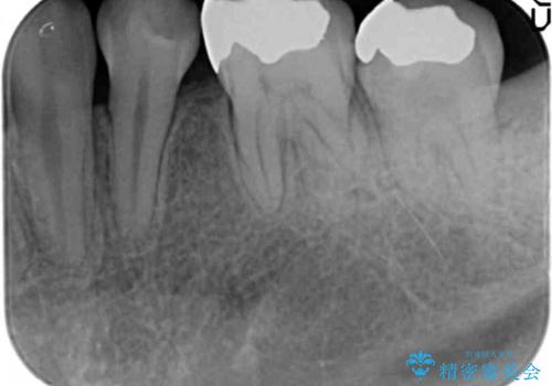 笑った時の印象を変えるメタルフリー治療の治療前