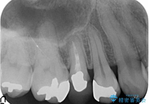 歯が欠けた セラミッククラウンで綺麗に 40代女性の治療前