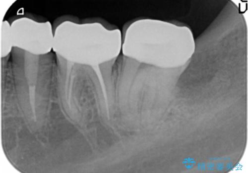 憧れの芸能人のような白い歯に 30代男性の治療後