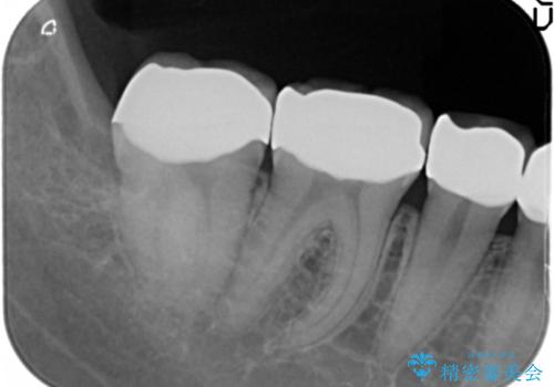 憧れの芸能人のような白い歯に 30代男性の治療後