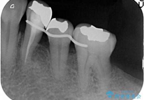 歯周病を治す 再生療法 50代男性の治療中