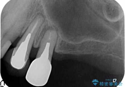 奥歯の違和感 再根管治療 40代女性