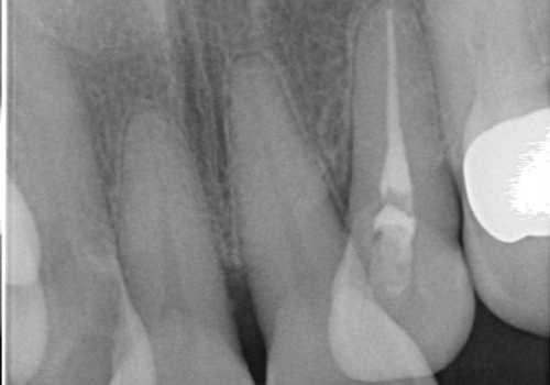 歯の動揺が気になる 低予算ではやく治したい 50代女性の治療前