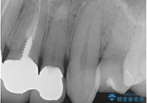 前歯のかぶせ物をオールセラミックへ 形を含めて理想の前歯への治療前