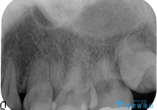 Kポップアイドルのような歯にしたい! 20代男性の治療前