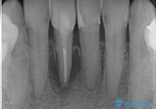 被せ物がかけた 綺麗で丈夫なセラミックのブリッジへ 60代女性の治療後