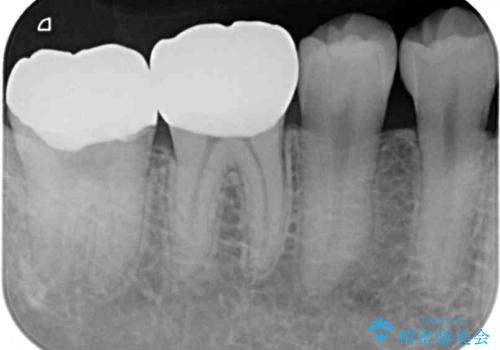 冷たいものがしみて奥歯が痛い 気になる歯並びも治したの治療後