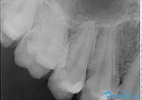 憧れの芸能人のような白い歯に 30代男性の治療前