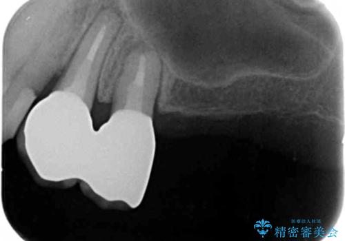 奥歯の違和感 再根管治療 40代女性の治療後