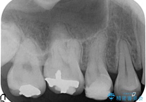 Kポップアイドルのような歯にしたい! 20代男性の治療前