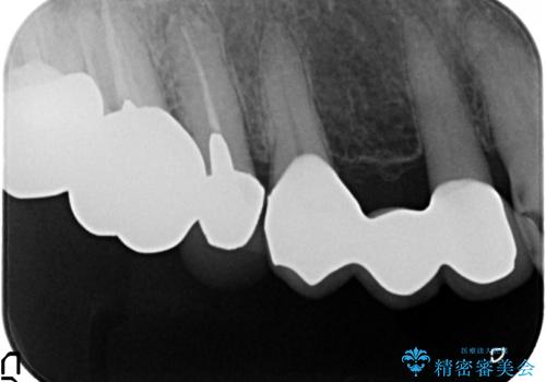 被せ物がかけた 綺麗で丈夫なセラミックのブリッジへ 60代女性の治療後