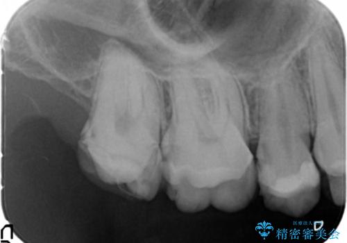 憧れの芸能人のような白い歯に 30代男性の治療前