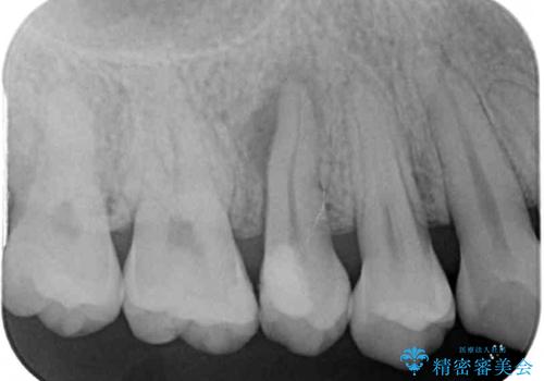 神経が死んで変色した歯 根管治療とオールセラミッククラウンの治療前