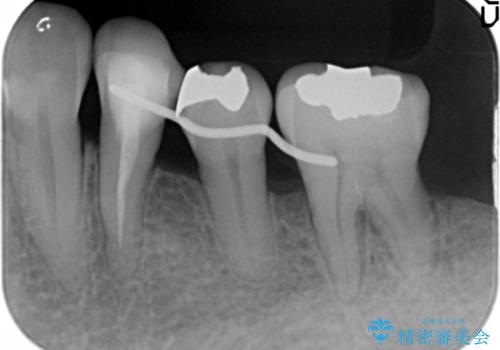 歯周病を治す 再生療法 50代男性の治療中