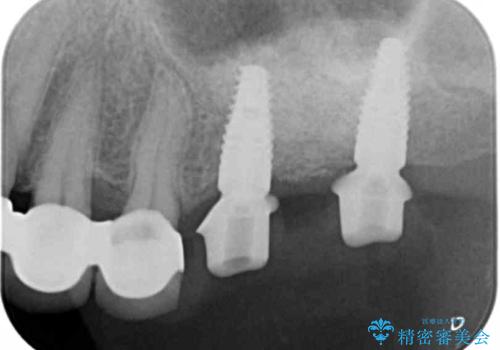 遊離端ブリッジ インプラント補綴への設計変更の治療中