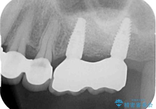 遊離端ブリッジ　インプラント補綴への設計変更の治療後