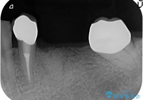 [ 2歯連続欠損 ] インプラントによる機能回復　の治療前