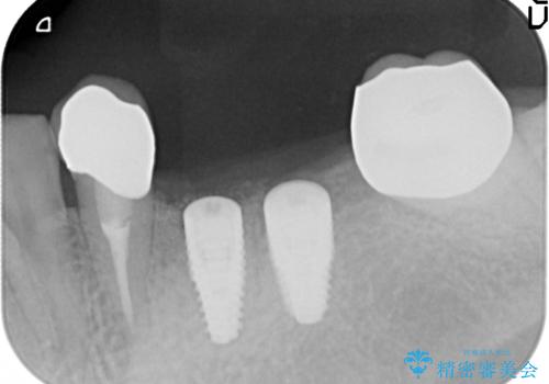 [ 2歯連続欠損 ] インプラントによる機能回復　の治療中
