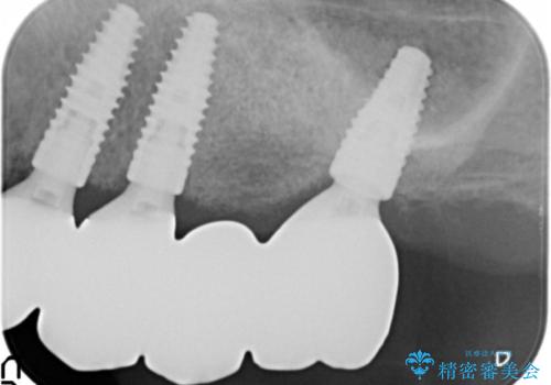 他院でインプラントできないと言われた 上顎洞底挙上術を併用したインプラント 50代男性の治療後