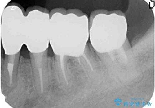 少ない残存歯質　抜歯ギリギリの歯を残すの治療後
