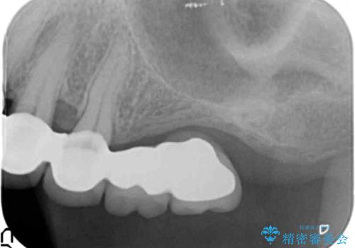 遊離端ブリッジ インプラント補綴への設計変更の治療前