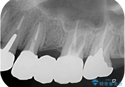 目立つ銀色の奥歯をセラミックに セラミックブリッジの治療後