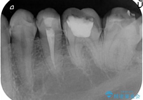 憧れの芸能人のような白い歯に 30代男性の治療前