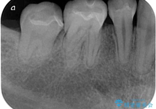 笑った時の印象を変えるメタルフリー治療の治療後