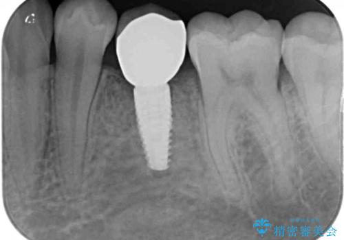 乳歯を抜いてインプラントに 咬み合わせ改善のインビザライン矯正の治療後