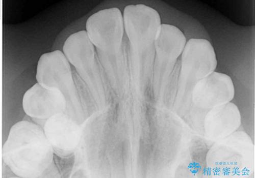 遠方から新幹線で通院 急速拡大装置とインビザラインによる矯正治療の治療前