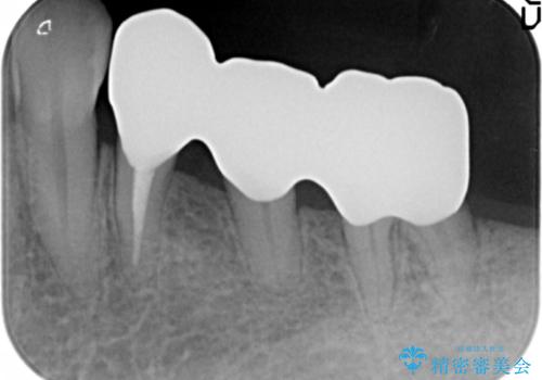 歯周病を治す 再生療法 50代男性の治療後