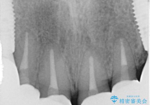 被せ物がとれたまま放置していた セラミックで綺麗に 50代男性の治療後