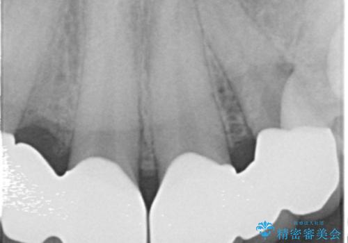 歯の位置異常 はやく治したい 矯正は嫌 20代女性の治療後