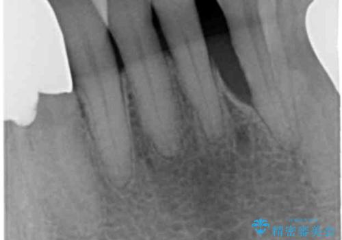 歯の動揺が気になる 低予算ではやく治したい 50代女性の治療前