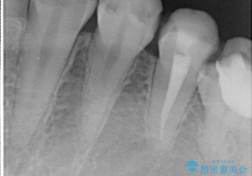 憧れの芸能人のような白い歯に 30代男性の治療前