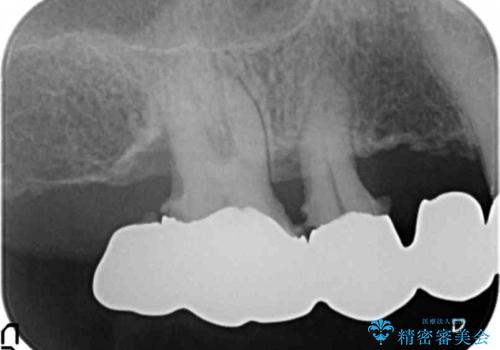 交通事故で前歯が折れた マグネットデンチャー 50代男性の治療前