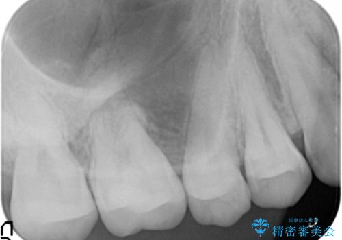 奥歯にフロスを通すと臭い 30代女性の治療後