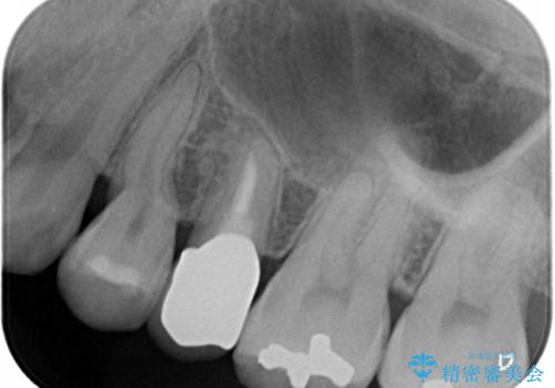 歯が欠けた セラミッククラウンで綺麗に 40代女性の治療後